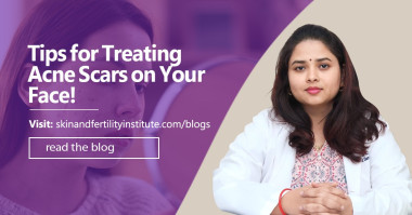 Tips For Treating Acne Scars on Your Face !