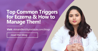 Top Common Triggers for Eczema and How to Manage Them!